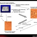 Sclérodermie systémique / atteinte vasculaire périphérique de la sclérodermie systémique