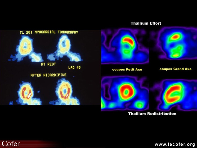 Sclérodermie systémique : atteinte cardiaque