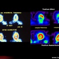 Sclérodermie systémique : atteinte cardiaque