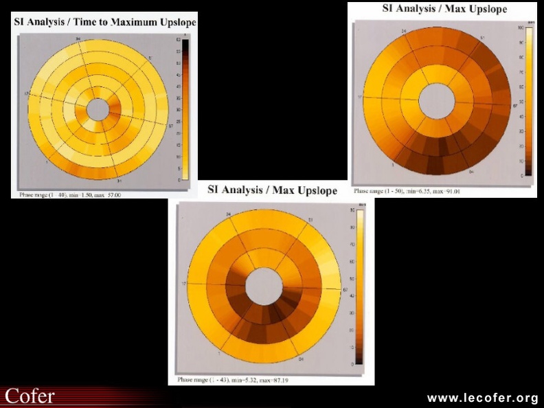 Atteinte coronarienne micro-circulatoire : effets de la Nifédipine, aspects IRM (perfusion), de gauche à droite : image normale, sclérodermie état basal, sclérodermie traitée par Nifédipine. 020502013.jpg
