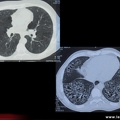 Sclérodermie systémique : Atteinte pulmonaire