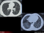 Sclérodermie systémique : Atteinte pulmonaire