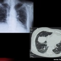 Sclérodermie systémique : Atteinte pulmonaire