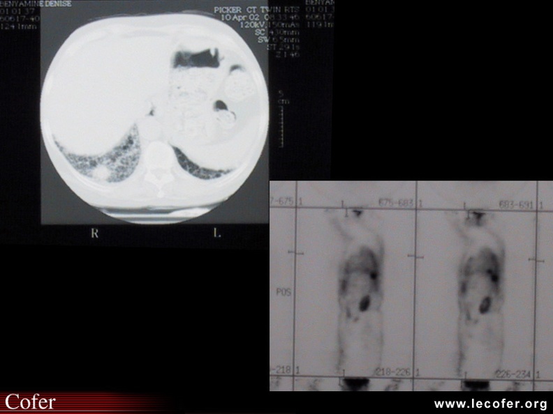 Sclérodermie nodule pulmonaire tumoral malin au sein de la fibrose : à gauche : scanner couches fines ; à droite : petscan. 020502017.jpg
