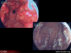 Sclérodermie systémique : atteinte digestive