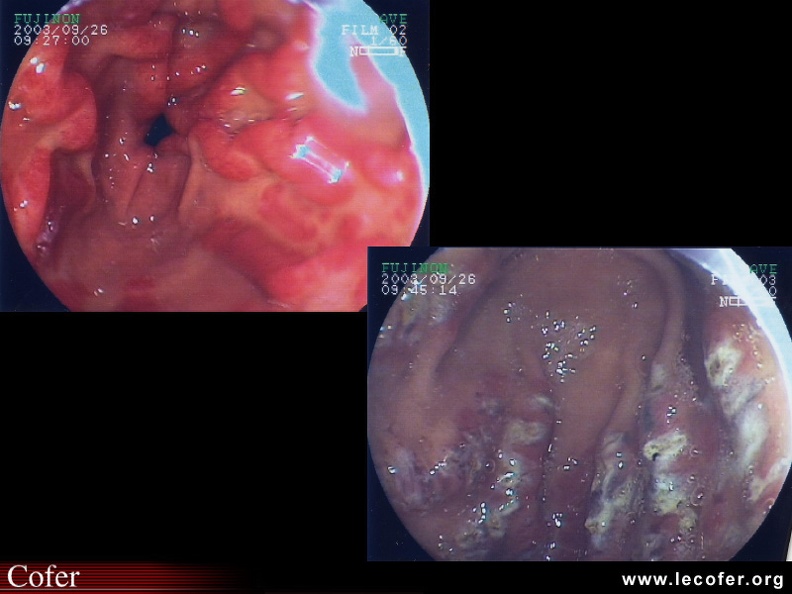Atteinte digestive : estomac pastèque : à gauche : fibroscopie estomac pastèque ; à droite : aspect après traitement laser. 020502020.jpg