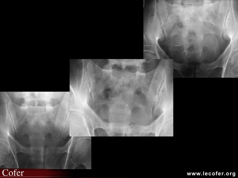Sacroiliite infectieuse à pyogènes. Évolution temporelle des clichés radiographiques. À gauche, symptomatologie évoluant depuis 3 semaines sans traitement, pas d'anomalies radiographiques. Au milieu, cliché réalisé 2 semaines après le premier, antibiothérapie débutée, érosions débutantes de l'articulation sacro-iliaque droite. À droite, après 2 mois d'antibiothérapie efficace, pseudo-élargissement de l'articulation sacro-iliaque, condensations osseuses. 0400020352.jpg