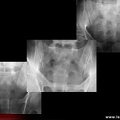 Sacroiliite infectieuse. Évolution temporelle de la radiographie