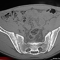 Sacroiliite infectieuse. Scanner