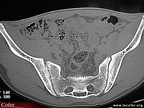 Sacroiliite infectieuse. Scanner