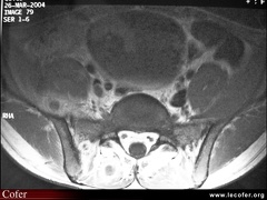 Sacroiliite infectieuse. IRM