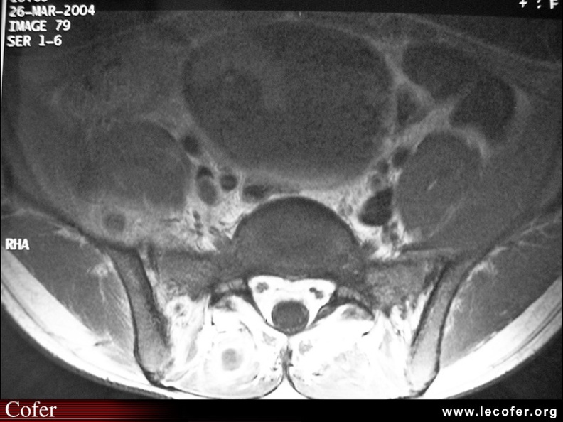 Sacroiliite infectieuse. IRM