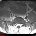 Sacroiliite infectieuse. IRM