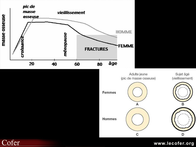 a. Évolution de la masse osseuse dans les deux sexes. Le pic de masse osseuse est plus élevé chez l'homme. La perte osseuse lente, liée au vieillissement, débute dans les deux sexes vers 35 ans. La ménopause est suivie d'une accélération de la perte osseuse pendant une dizaine d'années. Chez les sujets de plus de 70 ans, la perte osseuse est observée dans les deux sexes, due à une hyperparathyroïdie secondaire aux insuffisances calcique et vitaminique D.
b. Schéma illustrant les modifications des corticales. Les corticales sont plus épaisses chez l'homme adulte jeune. Au cours du vieillissement les corticales s'amincissent, mais moins que ne le voudrait la résorption endocorticale du fait d'une apposition périostée qui augmente le diamètre externe des os. Ce phénomène contribue à préserver la résistance mécanique osseuse. 050101008.jpg