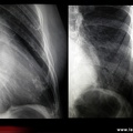 Radiographie normale des côtes