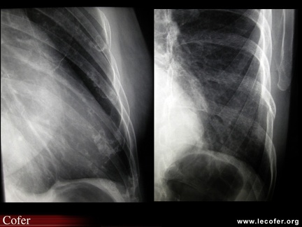 Radiographie normale des côtes
