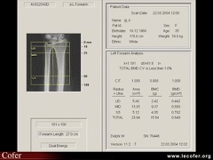 Densitométrie de l'extrémité inférieure du radius, DXA, absorptiométrie biphotonique à rayons X