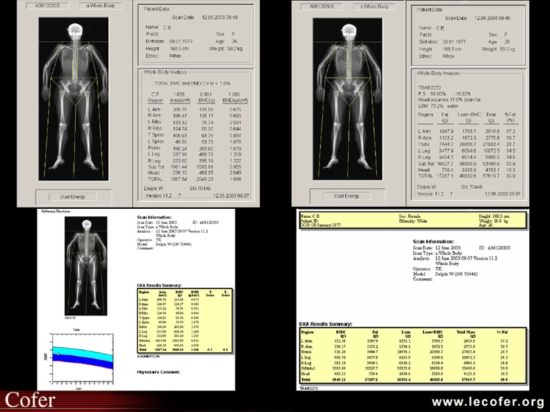 Densitométrie osseuse du corps entier, DXA, absorptiométrie biphotonique à rayons X