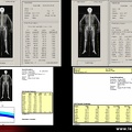 Densitométrie osseuse du corps entier, DXA, absorptiométrie biphotonique à rayons X