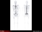 Scintigraphie osseuse : localisations métastatiques multiples : métastases osseuses