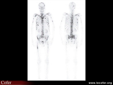 Scintigraphie osseuse : localisations métastatiques multiples : métastases osseuses