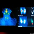 Hyperparathyroïdie