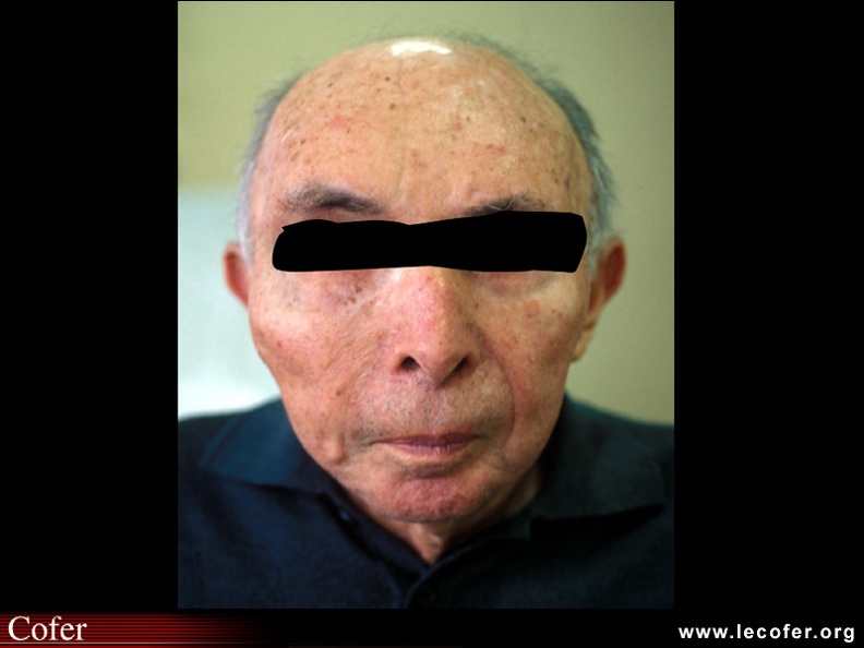 Maladie de Paget : Photographie de profil chez le même patient, montrant l'atteinte du malaire et du maxillaire supérieur ; noter la prothèse auditive pour améliorer une hypoacousie. 050201001.jpg