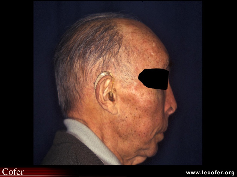 Maladie de Paget : Photographie de la tête de profil du même patient, montrant l'atteinte malaire et du maxillaire supérieur. Noter la prothèse auditive pour corriger une hypoacousie. 050201002.jpg