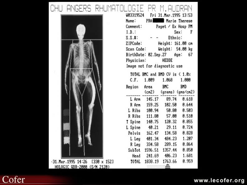 Maladie de Paget : Une densitométrie osseuse corps entier montre la forte augmentation du contenu minéral osseux du membre atteint : 404 g à gauche, versus 209 g à droite. 050201004ter.jpg