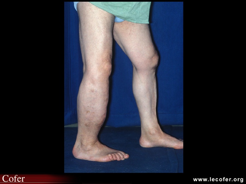 Maladie de Paget : Atteinte pagétique du tibia : déformation antéro-postérieure et hypertrophie de l'os ; noter les lésions cutanées et veineuses. 050201005.jpg