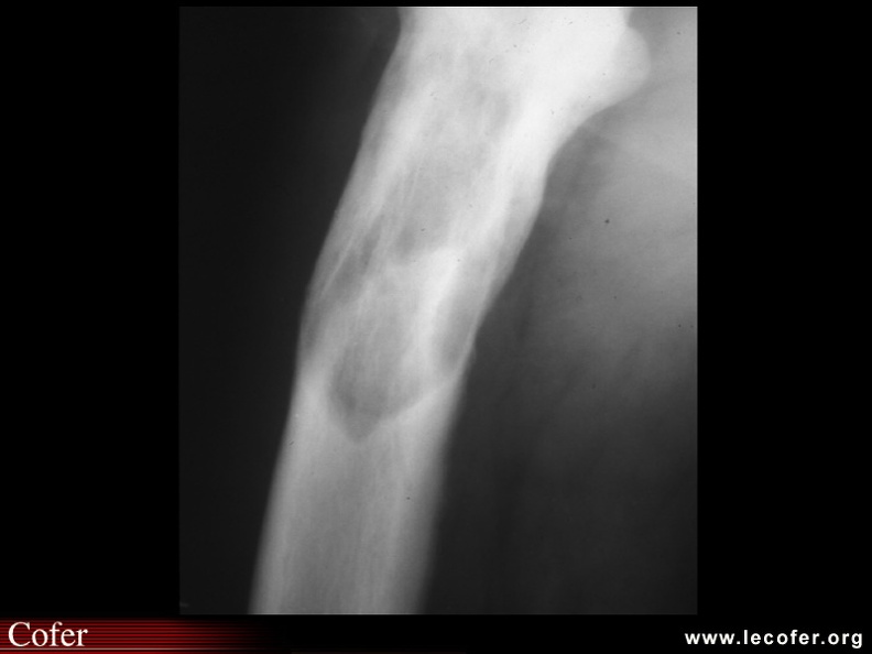 Maladie de Paget : Radiographie d'un tibia pagétique, montrant un volumineux front de résorption réalisant l'image en « V ». 050202005.jpg