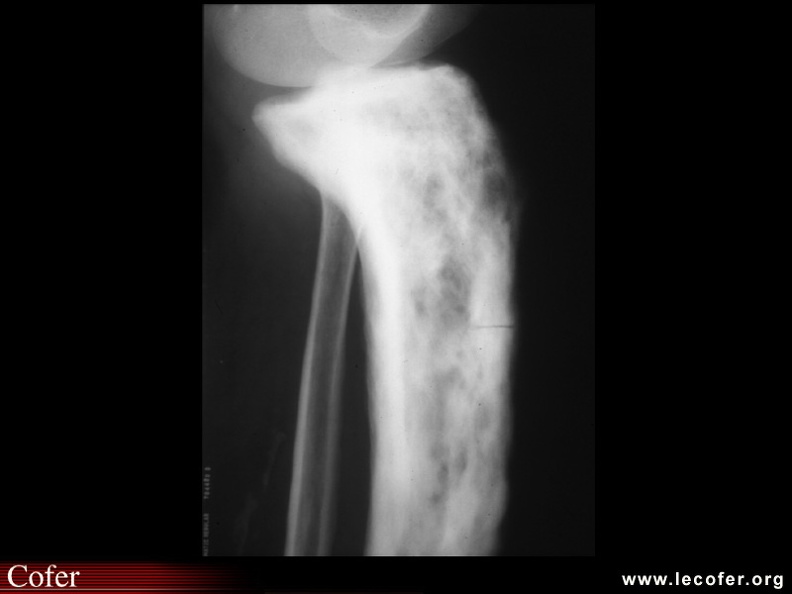 Maladie de Paget : Radiographie montrant sur un tibia pagétique du tibia une fissure typique dans la convexité. 050202007.jpg