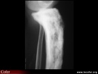Maladie de Paget : fissures dans la convexité d’un os long