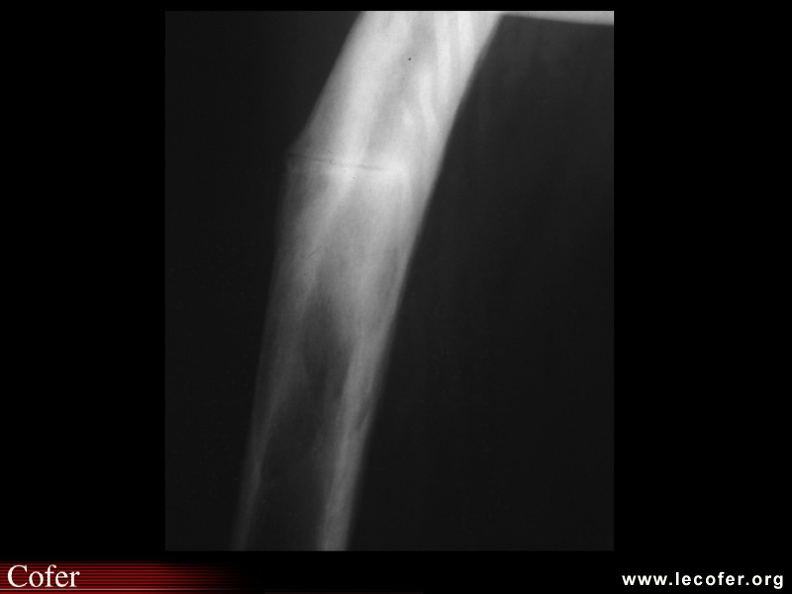 Maladie de Paget : Radiographie montrant sur un tibia pagétique du tibia une fissure typique dans la convexité, à un stade préfracturaire. 050202007BIS.jpg