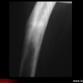 Maladie de Paget : fissures dans la convexité d’un os long