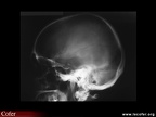 Maladie de Paget : crâne normal