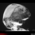 Maladie de Paget : ostéoporose circonscrite du crâne