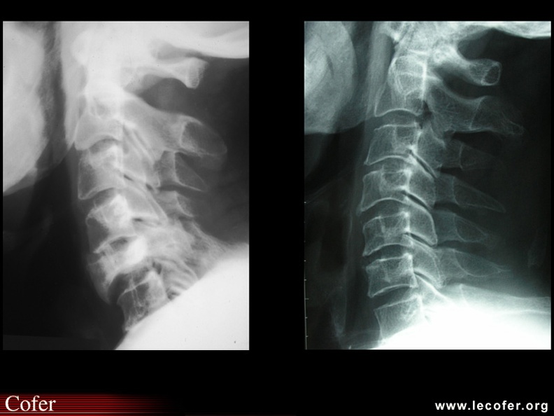 Maladie de Paget : radiographie du rachis cervical du patient précédent montrant l’atteinte pagétique de C5