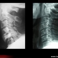 Maladie de Paget : radiographie du rachis cervical du patient précédent montrant l’atteinte pagétique de C5