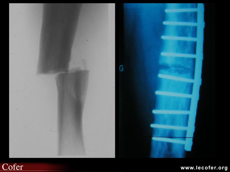 Maladie de Paget : fracture transversale du tibia « en coupe cigare »