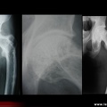 Dysplasie fibreuse : radiographie de lésions caractéristiques sur le fémur