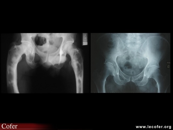 Dysplasie fibreuse : radiographie de lésions caractéristiques sur le fémur