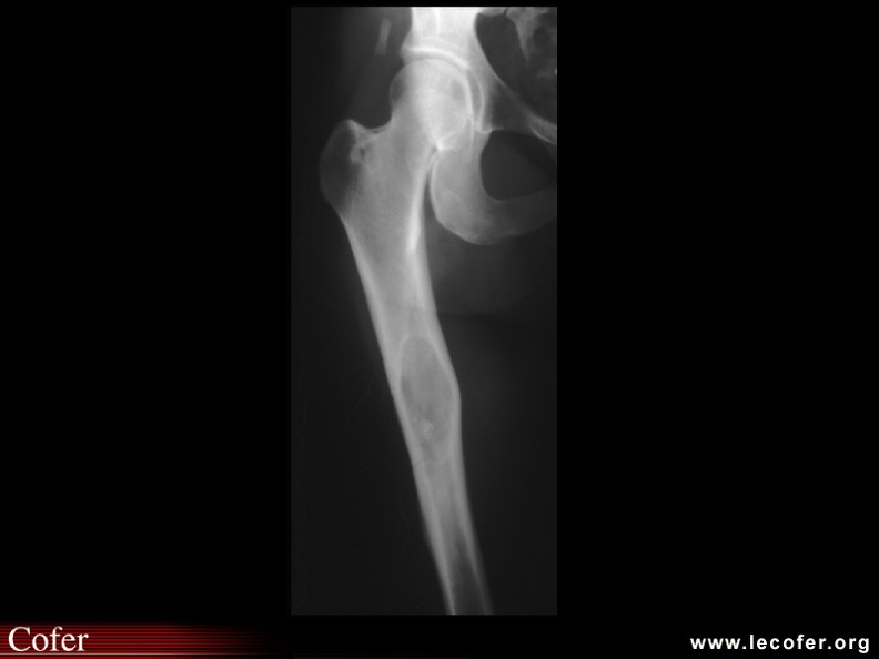 Dysplasie fibreuse : Lésions typiques de dysplasie fibreuse du fémur. 050202032ter.jpg