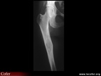 Dysplasie fibreuse : radiographie de lésions caractéristiques sur le fémur