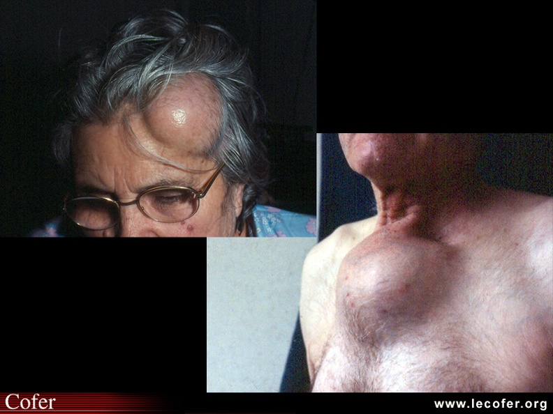 Myélome multiple : tumeurs plasmocytaires du crâne et du sternum. 050301001.jpg
