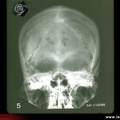 Myélome multiple : diagnostic différentiel des lacunes crâniennes : les empreintes vasculaires