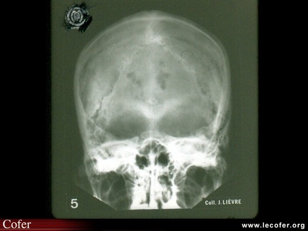 Myélome multiple : diagnostic différentiel des lacunes crâniennes : les empreintes vasculaires