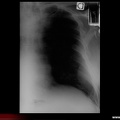 Myélome multiple : Radiographie : lyse costale accompagnée d’une réaction pleurale