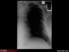 Myélome multiple : Radiographie : lyse costale accompagnée d’une réaction pleurale