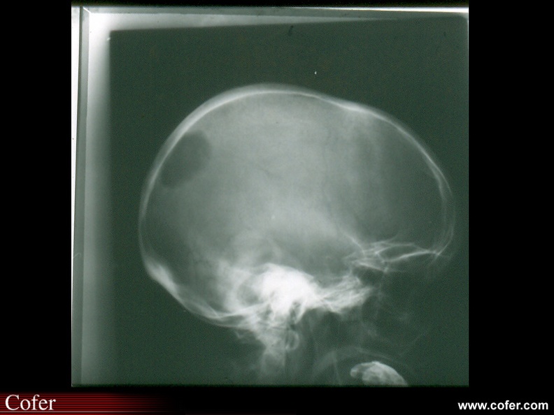 Métastases osseuses : Métastase lytique du crâne à bords nets, non cerclée, en provenance d'un cancer de l'estomac. 050302021.jpg